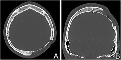 A Large Skull Defect Due to Gorham-Stout Disease: Case Report and Literature Review on Pathogenesis, Diagnosis, and Treatment